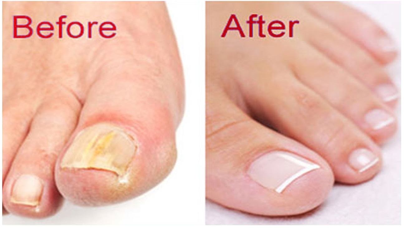 Image result for rid of your fungal nails